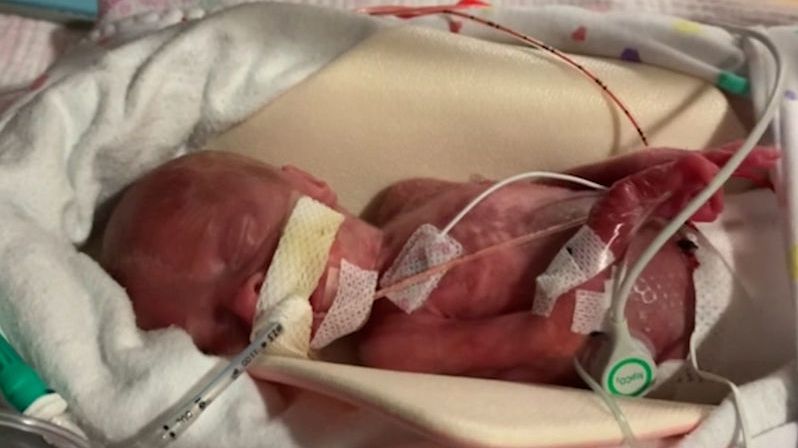Narodila se ve 22. týdnu těhotenství, lékaři ji zachránili i díky igelitovému sáčku